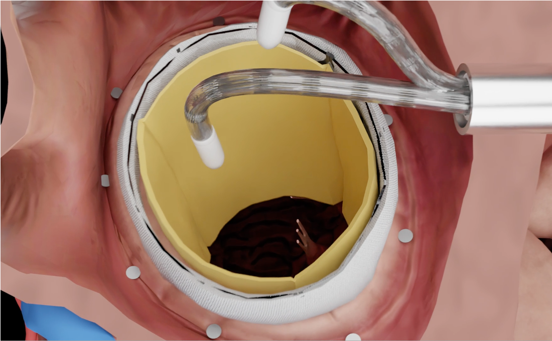 SYNCRA robotic catheter — concept render